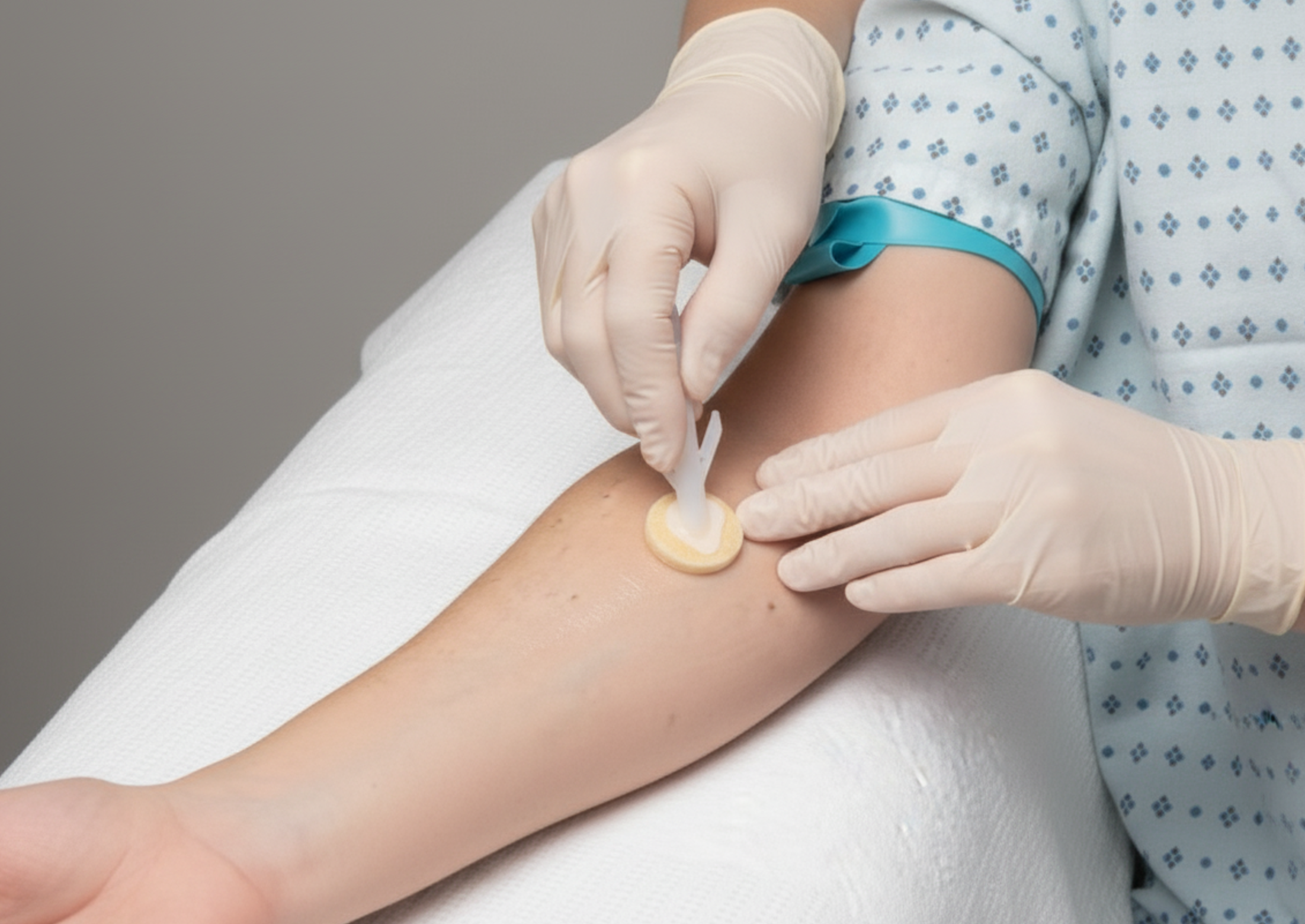 Skin Antisepsis Technique - Proper chlorhexidine application and dry time